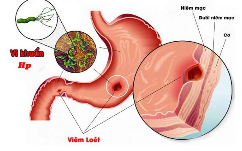 Vi khuẩn HP dương tính có nguy hiểm không hay chỉ là một hiểm họa nhỏ?