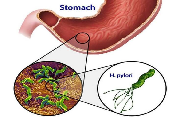 Vi khuẩn HP là gì?